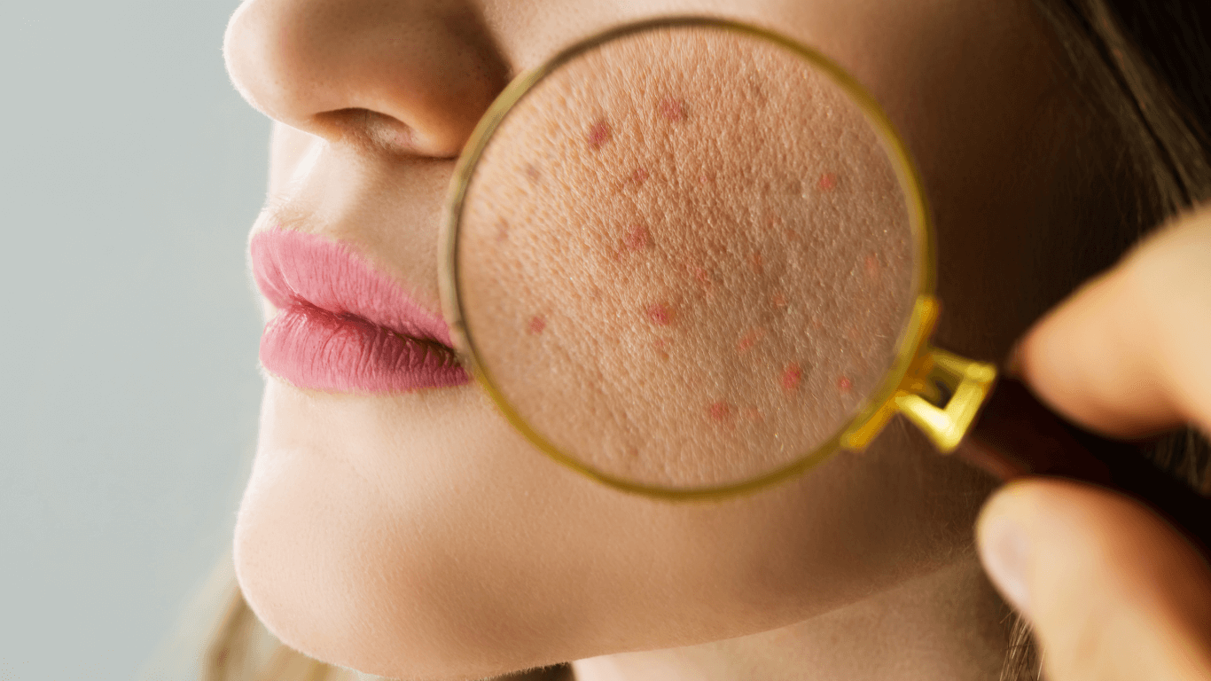 Da dầu mụn là vấn đề da liễu phổ biến và gây nhiều trở ngại trong quá trình chăm sóc da
