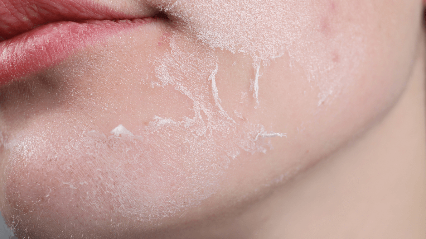 Skincare cho da khô chưa hiệu quả