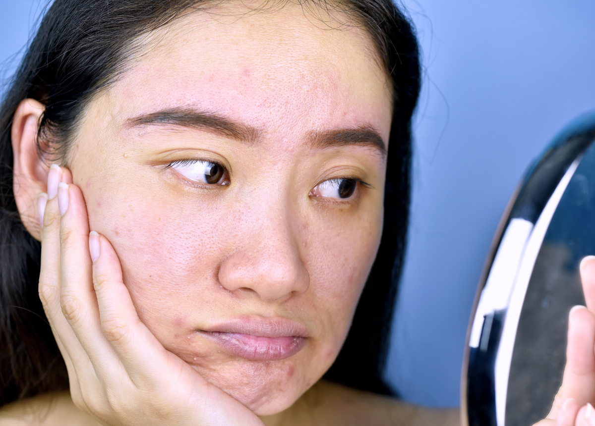 Hiện tượng da xỉn màu vào mùa lạnh là gì