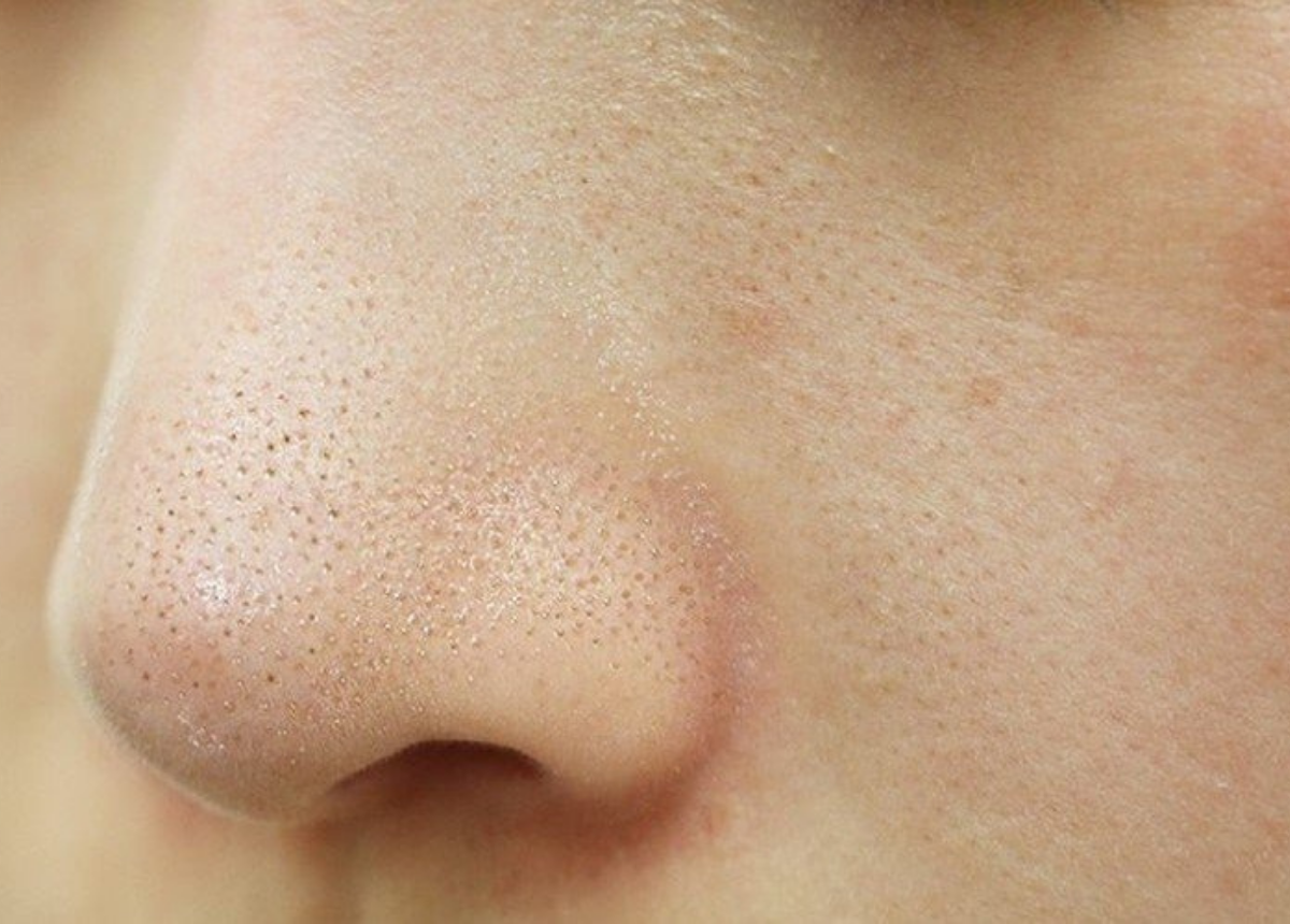 Nguyên nhân khiến lỗ chân lông giãn nở và hình thành mụn đầu đen