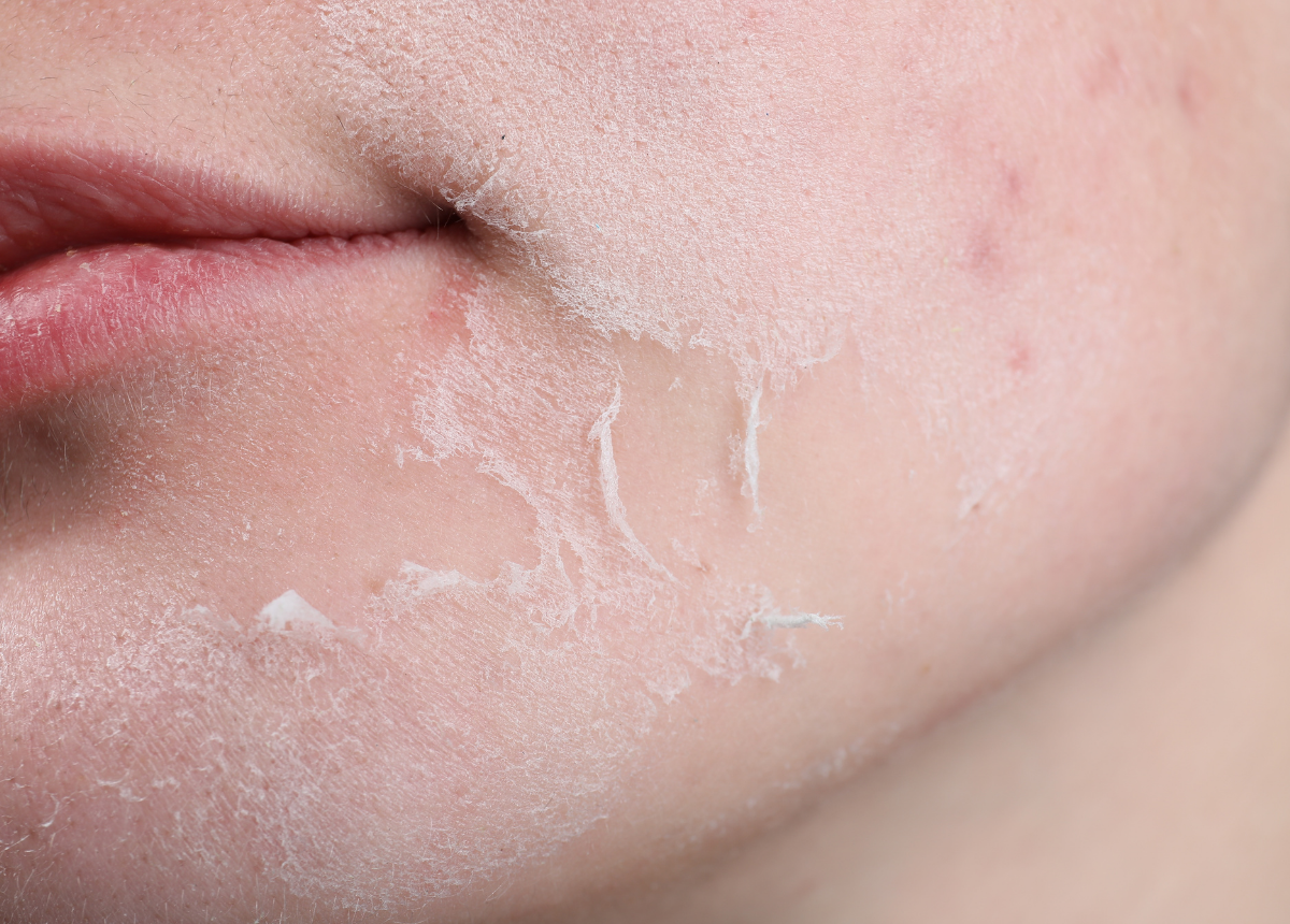 Những sai lầm thường gặp khi không thay đổi skincare theo mùa