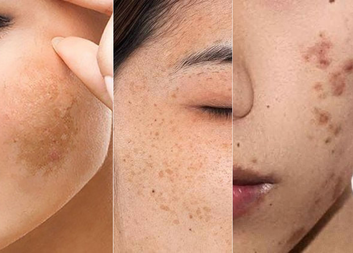 Phân biệt nám, đốm nâu và tàn nhang