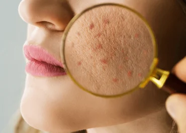 Top 5 thành phần mỹ phẩm tốt nhất cho da dầu mụn